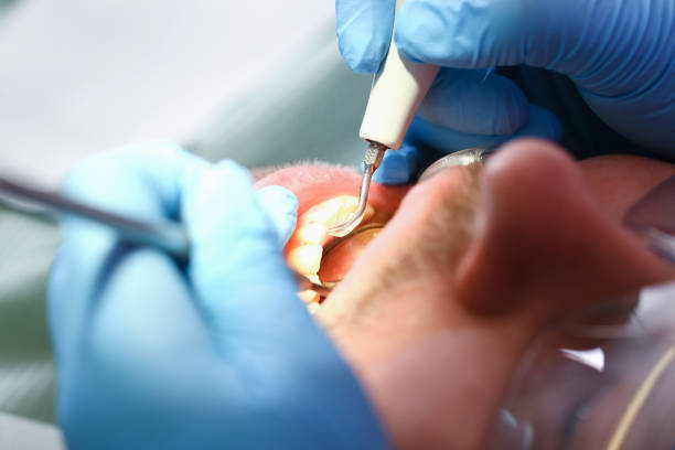 Best Knocked-Out Tooth (Avulsed Tooth) Treatment in Davis, CA